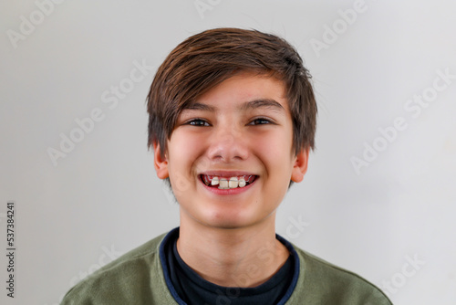 Children tooth care and hygiene. Portrait of a teenager boy with diastema overbite teeth missing gap wearing orthodontic appliance treatment. Dental braces with child concept. photo