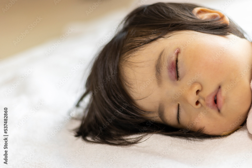 目をぶつけて、まぶたが腫れて内出血している赤ちゃん(2歳3か月、女の子、日本人) 目をぶつけて、まぶたが腫れて内出血している赤ちゃん(2歳3か月、女の子、日本人)