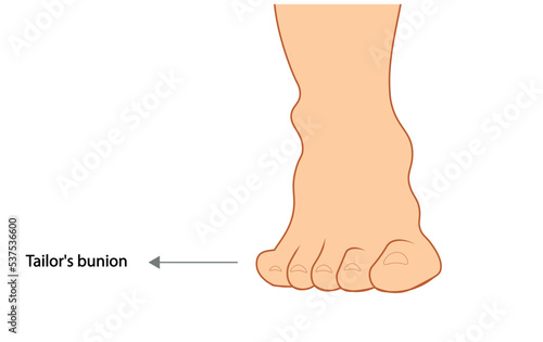 Tailor's Bunion illustration. Frontal view of a foot with a Tailor's bunion.