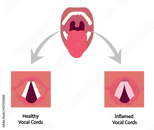 Laryngitis illustration. Healthy and inflamed vocal cords illustration