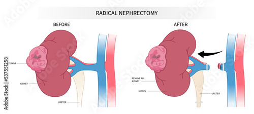 kidney donation with Laparoscope minimally invasive surgery of Nephrectomy swelling organ artery tract stenosis