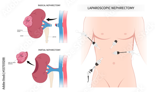 Laparoscope minimally invasive surgery for swelling kidney organ donation with Nephrectomy artery tract stenosis photo