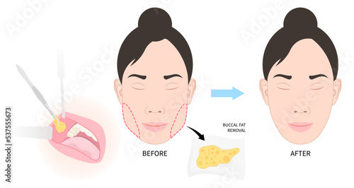 Cheek buccal fat removal and augment excess slim face of Bichat’s procedure photo