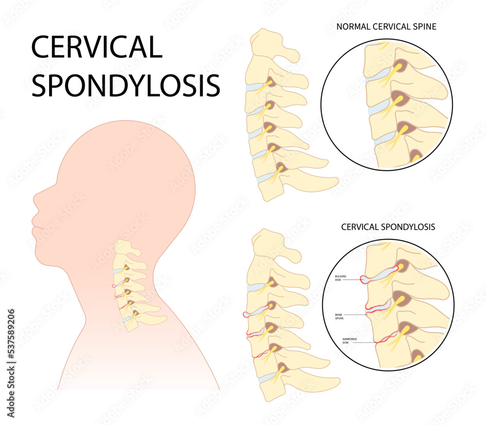 Tingling Numbness hand of spine degeneration thoracic neck root injury