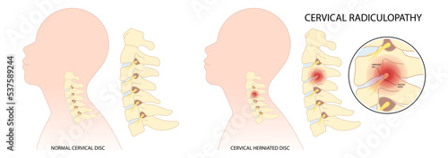 Herniation bone disk of neck and thoracic outlet syndrome root injury pain damage spine canal degeneration traumatic spurs painful Spinal cord pinched nerves Tingling Numbness hand