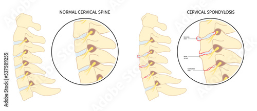Spinal cord pinched nerves and painful Tingling Numbness hand of thoracic neck root injury outlet pain damage spine canal syndrome degeneration Herniation traumatic bone disk spurs