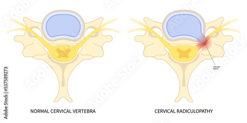 traumatic Spinal cord injury with painful pinched nerves Tingling Numbness hand thoracic neck root outlet pain damage spine canal syndrome degeneration Herniation bone disk spurs