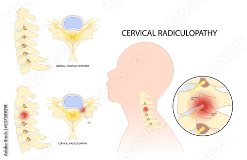 neck root injury with thoracic outlet pain damage spine canal syndrome or degeneration Herniation traumatic bone disk spurs painful of Spinal cord pinched nerves Tingling Numbness hand