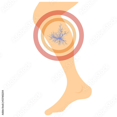 Spider Veins on Skin. Human Vessel, Health Arteries. Red Blood. Varicose.