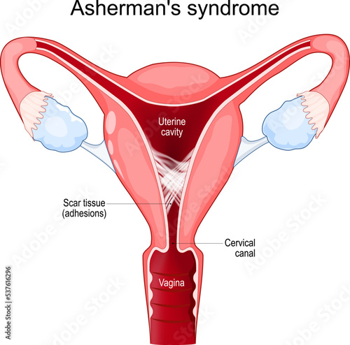 Asherman's syndrome. Cross section of uterine with adhesions photo