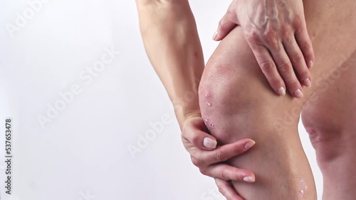 Psoriatic arthritis with skin psoriasis on a woman's knees. Inflammatory arthritis causing swelling, stiffness, redness, pain, and joint damage. Synovial fluid with psoriasis of the left knee.