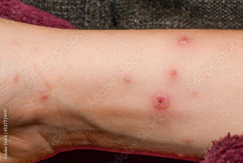 Chickenpox on the body of a child, Severe chicken pox crusts on rashes. papules and blisters. photo