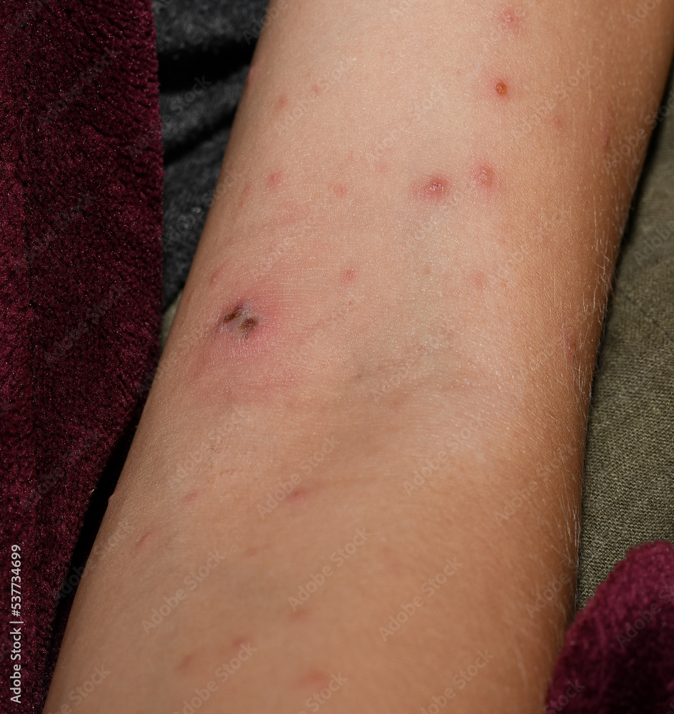 Chickenpox on the body of a child, Severe chicken pox crusts on rashes. papules and blisters. Chickenpox on the body of a child, Severe chicken pox crusts on rashes. papules and blisters.