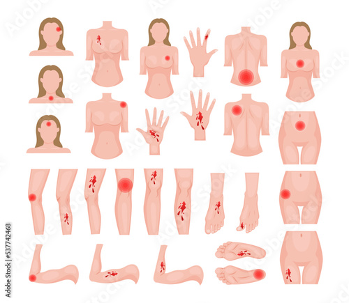 Traumas of skin on body parts set. Vector illustrations of open cut wounds with bleeding, fracture and bruise. Cartoon hurt to elbow leg shoulder knee arm finger isolated on white. Injury concept