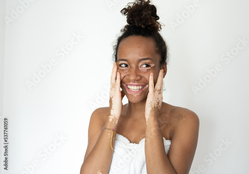 Beautiful young brazilian woman with vitiligo posing with towel, skin care and genetic pigmentation concepts, smiling people and body positive concept, white background
