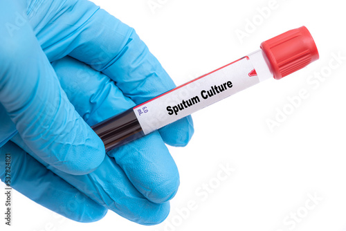 Sputum Culture Medical check up test tube with biological sample photo