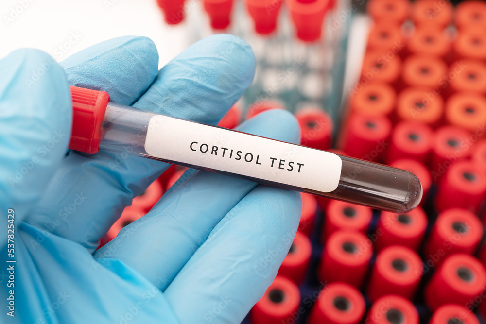 Hand holding a glass of test tube with patient's blood for testing cortisol Hand holding a glass of test tube with patient's blood for testing cortisol