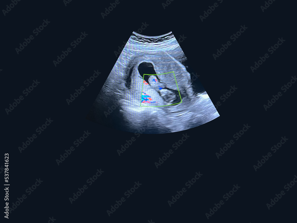 8 Weeks Pregnant Is Your Baby At 8 Weeks Ultrasound Developing Properly - ir07x7f