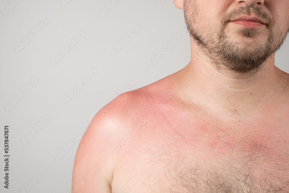 Fototapeta premium Skin of a person with sunburn, redness of the skin, close-up, space for text.