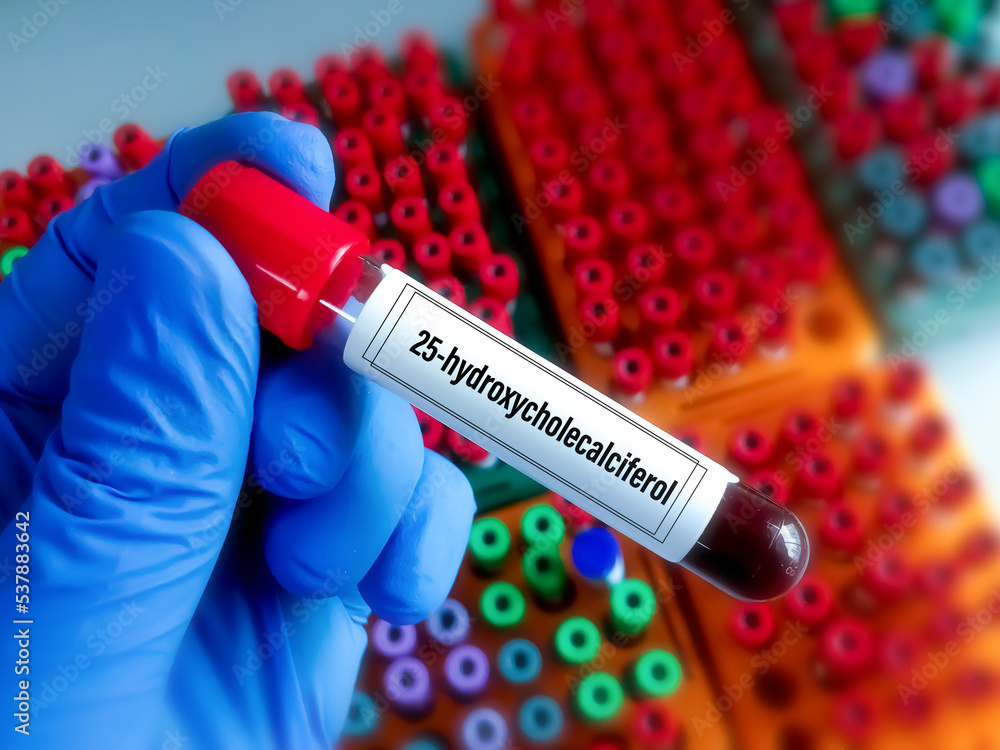 Obraz premium Blood sample for 25-hydroxycholecalciferol test, also known as 5-hydroxyvitamin D₃, calcifediol or calcidiol, is a form of vitamin D produced in the liver by hydroxylation of vitamin D₃