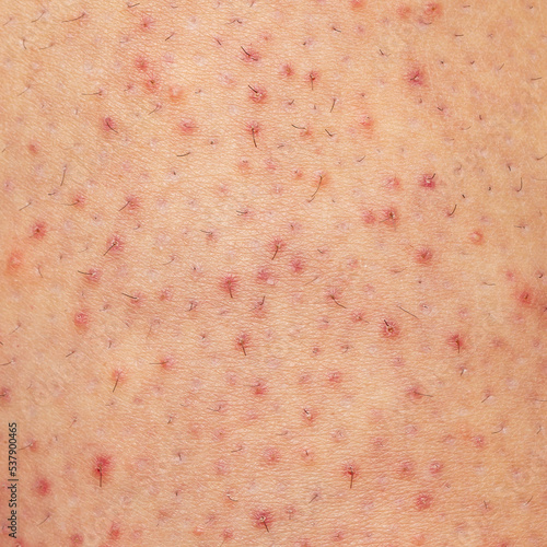 Macro of female skin with folliculitis