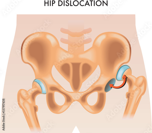 Medical illustration of the hip dislocation.