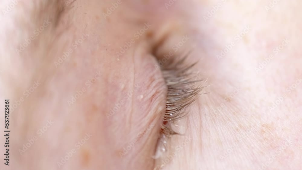 Closeup young man drops eye drops install lenses, moisturizing, using medical eyes drops suffering from dry eyes syndrome or curing ophthalmology disease, lady having blurred eyesight, treating eyes Closeup young man drops eye drops install lenses, moisturizing, using medical eyes drops suffering from dry eyes syndrome or curing ophthalmology disease, lady having blurred eyesight, treating eyes