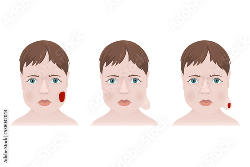 Types of hemangiomas on the face of a child. Medical poster vector illustration