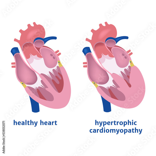 Hypertrophic cardiomyopathy. Expansion of the ventricle of the heart. Medical poster vector illustration