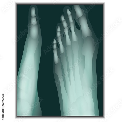 X-ray of Foot - Fla source file available