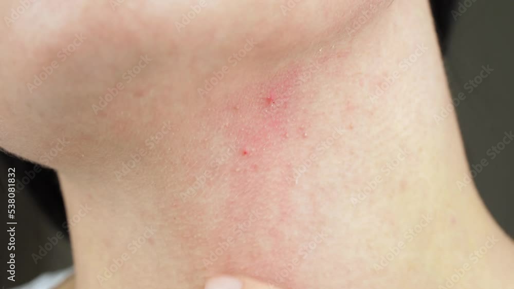 A close-up hand touches a red inflamed acne. Allergic reaction, dermatitis. Cosmetology. A close-up hand touches a red inflamed acne. Allergic reaction, dermatitis. Cosmetology.