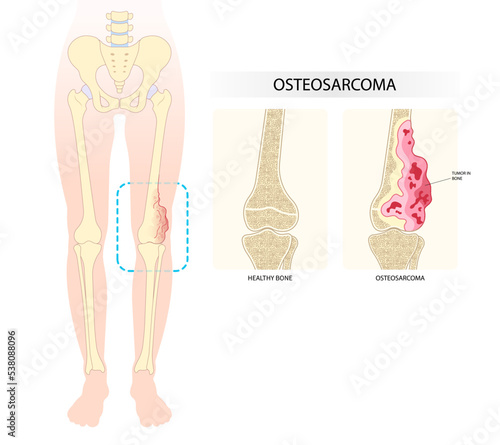 Medical anatomy leg bone pain of The Ewing's sarcoma tumor cell with hip femur gross and soft tissues gene mutation chromosomal inflammation of chondrosarcoma by needle transplant photo
