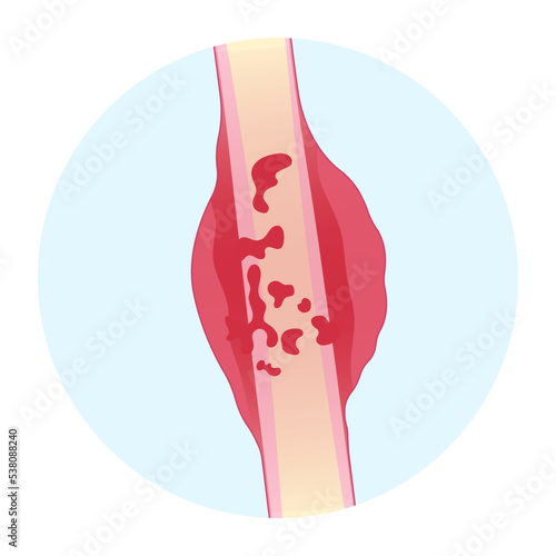 tumor cell with hip femur with The Ewing's sarcoma gross leg bone pain and soft tissues gene mutation chromosomal inflammation of chondrosarcoma by needle transplant