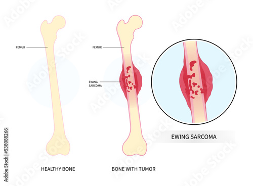 Medical anatomy leg bone pain of The Ewing's sarcoma tumor cell with hip femur gross and soft tissues gene mutation chromosomal inflammation of chondrosarcoma by needle transplant