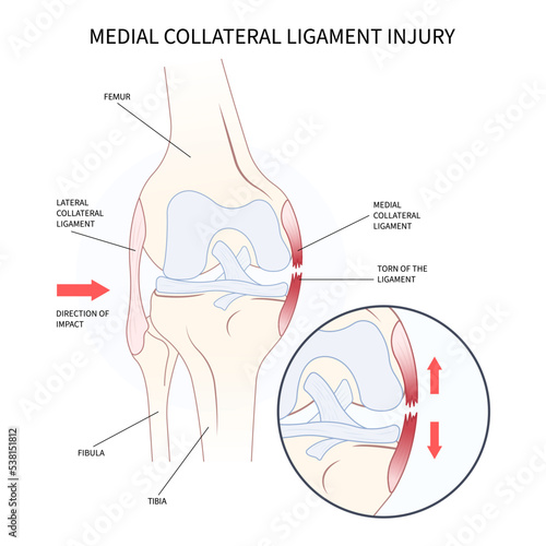 Medial collateral ligament Injury with athletic pop meniscal femur Grade or hurt test photo