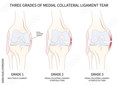 classification of Medial collateral ligament Injury test athletic meniscal femur pop hurt grade