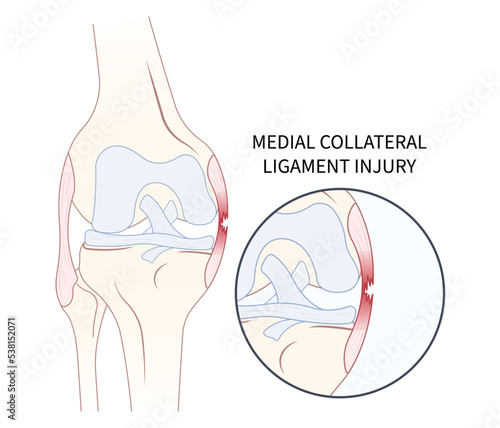 Left lateral Medial collateral ligament Injury with pop femur of athletic meniscal test Grade hurt