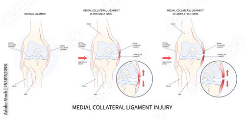 Knee athletic meniscal femur Injury test Medial collateral ligament pop Grade hurt photo
