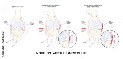 Knee athletic meniscal femur Injury test Medial collateral ligament pop Grade hurt