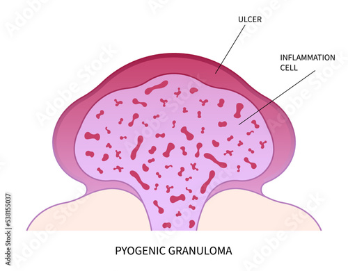 pyogenic granuloma skin tumor disease