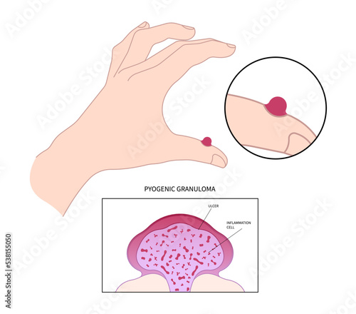 Hand and fingers with pyogenic granuloma skin tumor disease