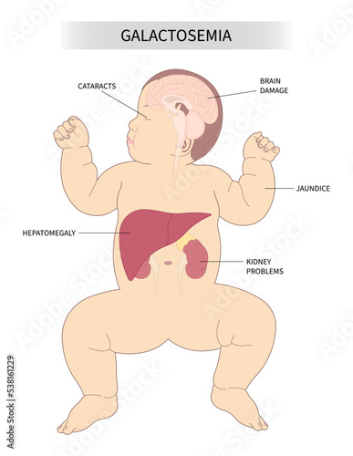 galactosemia yellow skin and eyes or jaundice disorder