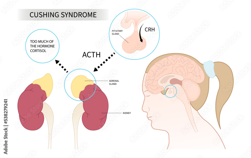 Cushing's or dowager's syndrome and Weight Gain fatty back neck obesity