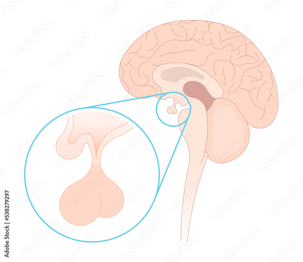 Brain of Cushing's or dowager's Weight Gain syndrome fatty back neck