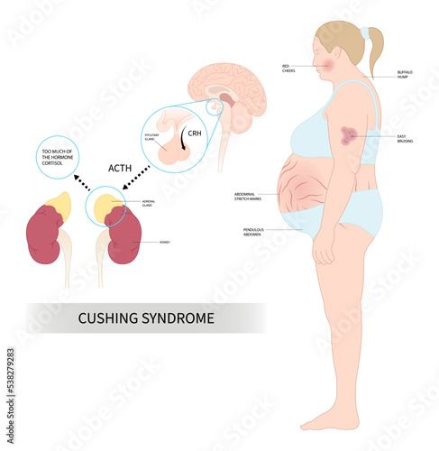 Cushing's or dowager's syndrome and Weight Gain fatty back neck obesity with hypertension high blood pressure