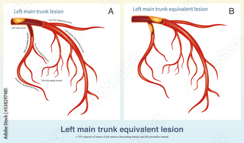 When the left anterior descending branch and left circumflex branch are severely stenosed, is called the left main trunk equivalent disease.The risk is the same as that of left main trunk disease. photo