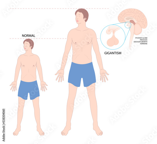 body giant or acromegaly enlargement Insulin like Factor hormonal