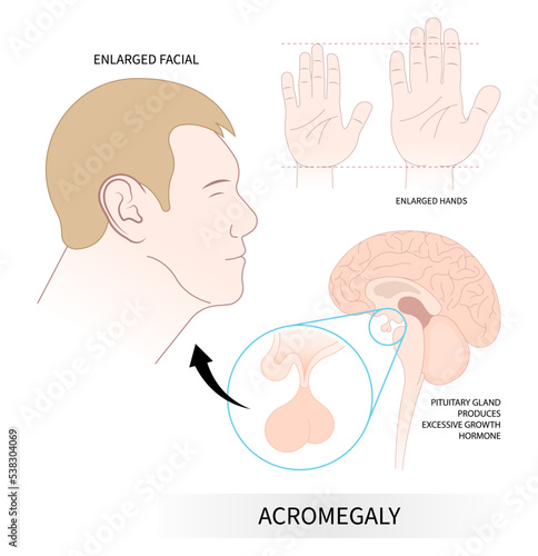 enlargement body of acromegaly giant with Insulin like Factor hormonal