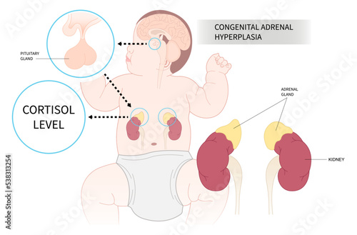 Infant with Cushing’s syndrome and Adrenal Disorder with Addison’s or Adrenocortical carcinoma gene mutation Corticosteroid photo