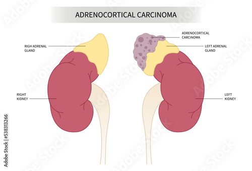 Kidney carcinoma gene mutation Adrenal Disorder with Addison’s or Cushing’s syndrome Adrenocortical and Corticosteroid